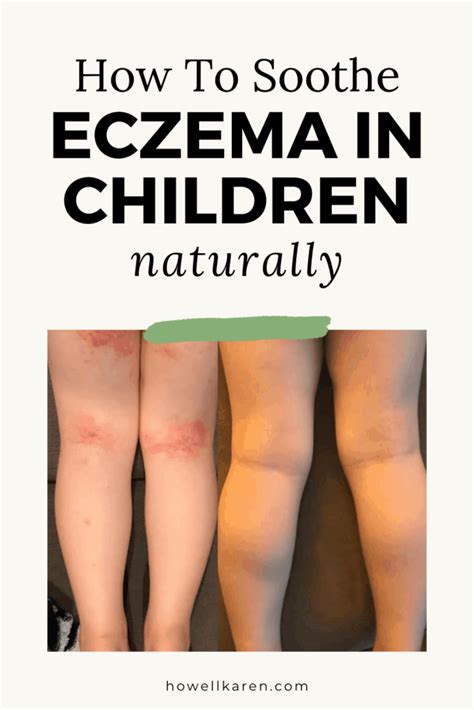 How To Soothe Eczema In Children Karen Howell