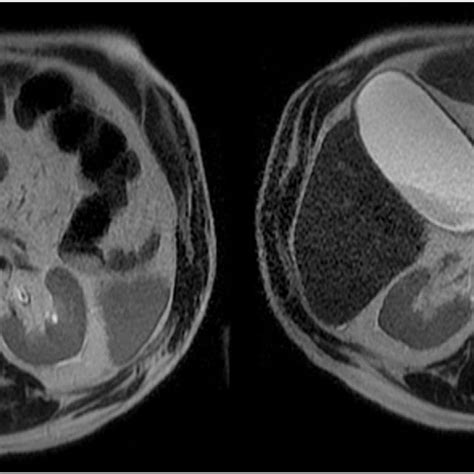 Mri Confirms The Ct Scan Evidence Of Partial Dorsal Agenesis Of The