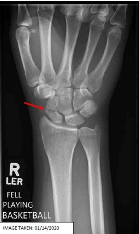 Scaphoid Fracture Treatment Symptoms And Recovery Vrogue Co