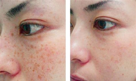 Da mặt sạm đen là bệnh gì và cách chăm sóc đúng cách VIETSKIN