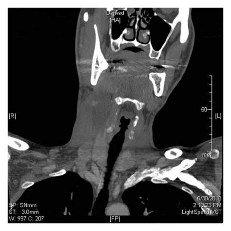 Coronal View Of A Ct Scan With Contrast Showing Right Cystic Neck Mass