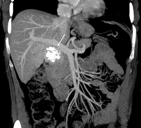 Case 306 Ectopic Thyroid Goiter In The Porta Hepatis Radiology