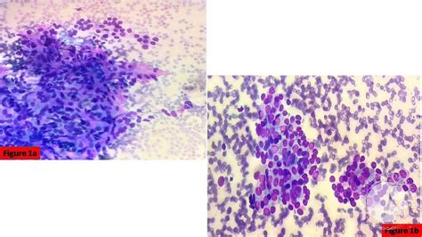A Unique Case Presentation Of Thyroid Carcinoma With Skip Metastasis To