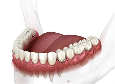 Partial Denture Lakeshore Dental