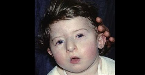 Digeorge Syndrome Symptoms Causes And Treatment