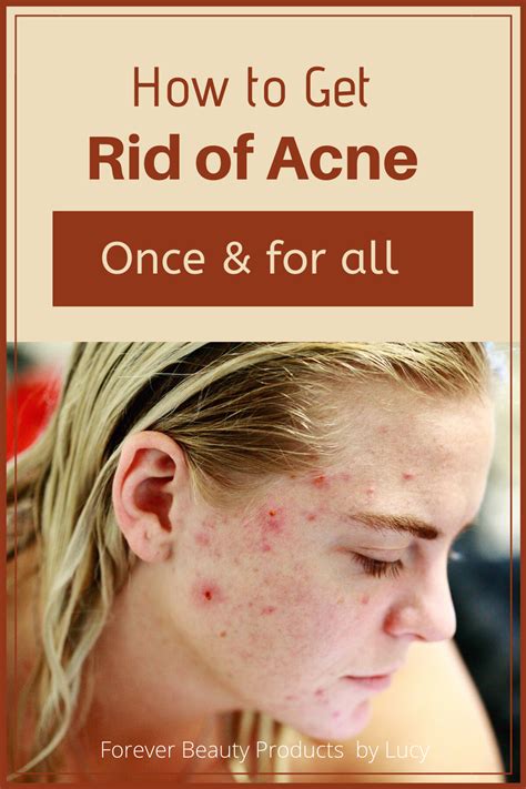 How To Get Rid Of Acne Forever Beauty Products By Lucy