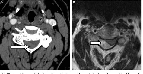 Figure 1 From Spontaneous Cervical Epidural Hematoma Mimicking Stroke