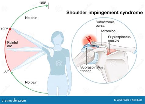 Shoulder Impingement Painful Arc Labeled Illustration Stock