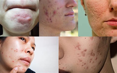 Why Is Popping Pimples Bad For Your Skin Reequil