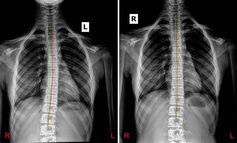 Chiropractic Biophysics Foundation Spine And Posture