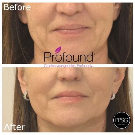 Adding Radiofrequency Rf Injectable Energy To Microneedling The Profound® System Provides A