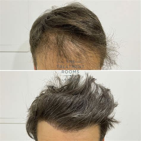 Tips For A Successful Hair Transplant Book A Consultation