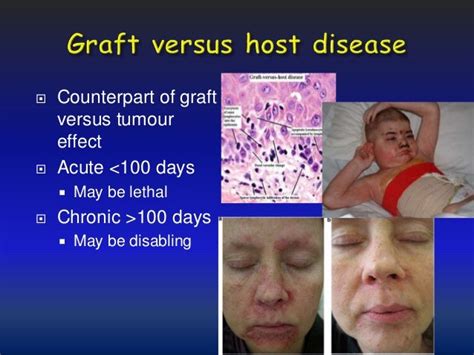 Graft Versus Host Disease Graft Versus Host Disease Hildegard T