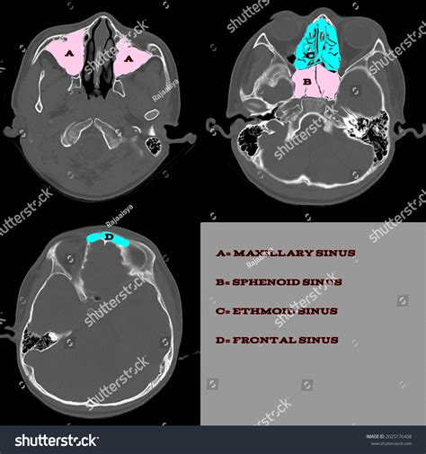 Anatomy Paranasal Sinuses Ct Scan Vector Stock Vector Royalty Free