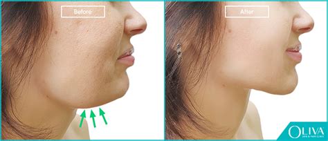 Non Surgical Double Chin Treatment Benefits Cost And Results