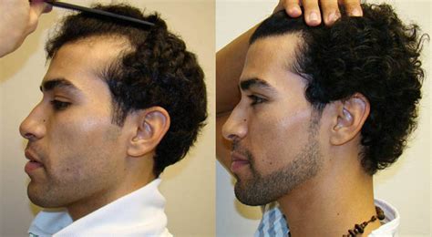 Receding Hairline Restored Even For Young People