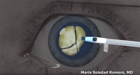 Precision Eye Cataract And Laser Eye Surgery Optometrist Baltimore