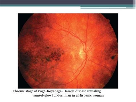 Vogt Koyanagi Harada Disease