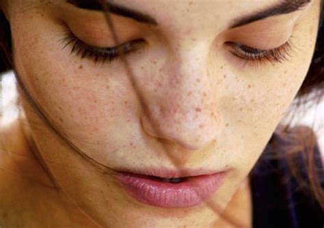 Dark Spots On Your Face Causes And Remedies Md