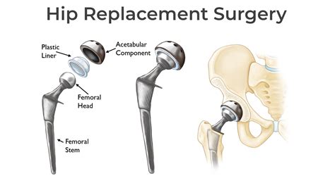 Different Types Of Hip Replacement Implants Capsur Enterprises