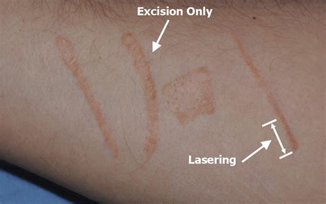 Scar Revision Before After Images Seattle Bellevue
