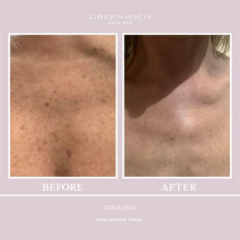 Coolpeel Co Laser Treatment Greenwich Medical Spa Connecticut