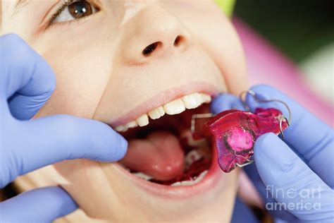 Dental Braces Photograph By Microgen Images Science Photo Library Fine Art America