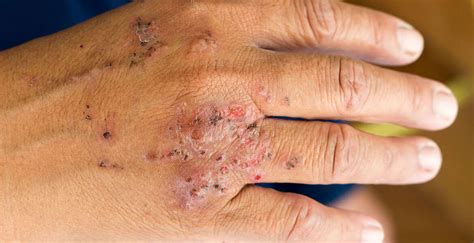 What Is Contact Dermatitis Tec Labs Hot Sex Picture