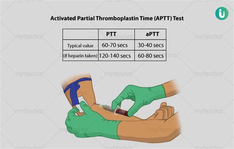 Explains how the partial thromboplastin time (ptt, aptt) is used, primarily to investigate unexplained bleeding or clotting. APTT (Activated Partial Thromboplastin Time) Test: Procedure, Purpose, Results, Normal values ...