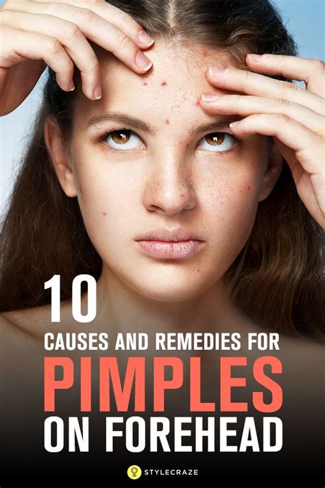 How To Get Rid Of Pimples On Forehead Pimples Remedies Pimples On Forehead Home Remedies For
