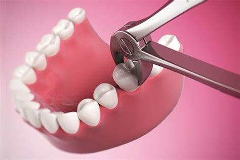 They are usually only set in response to actions made by you which amount to a request for services, such as setting. Tooth Extraction, When Necessary, Is Not Bad | Wisdom ...