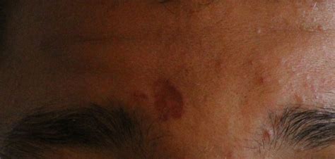 Huge Dark Spot After Popping Pimple Hyperpigmentation Reddark