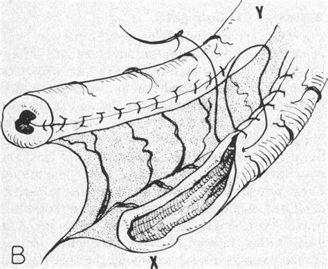 Operative Procedure A Blunt Dissection Between The Peritoneal Leaves