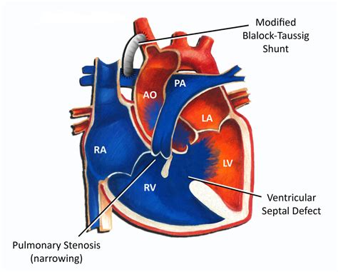 Tetralogy Of Fallot Pediatric Heart Specialists