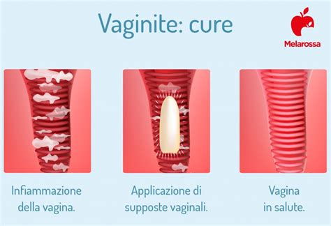 Vaginite cosè tipi cause sintomi e trattamenti Melarossa