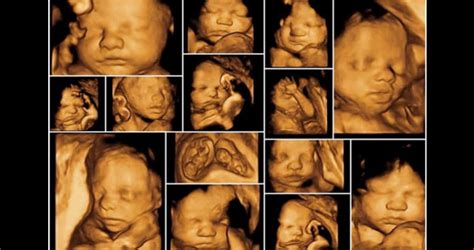 Sonograma 3d Revelación Del Genero Del Bebé 4 Imágenes A Color 10