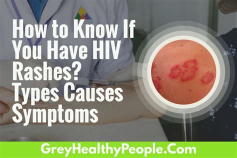 How To Know If You Have An Hiv Rash Hiv Rashes Types Causes