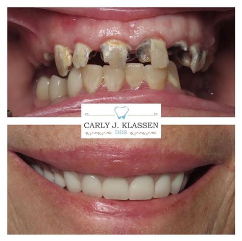Full Mouth Restoration Carly J Klassen Dds
