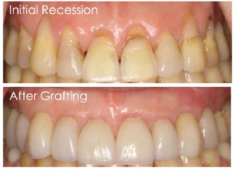 Tissue Grafting With A Multi Disciplinary Approach Anderson