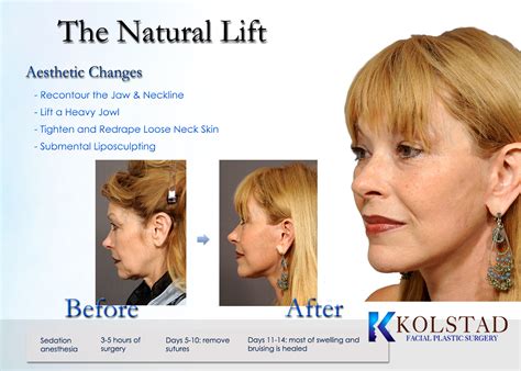 Facelift San Diego | Neck Lift La Jolla | Dr. Kolstad