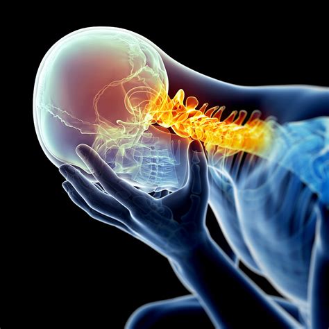 Neck Pain Series Part 2 Cervicogenic Headache