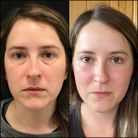 Lower Blepharoplasty Before And After Photos Flora Levin Md
