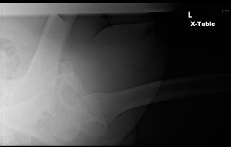 Ortho Dx Posterior Hip Dislocation After An Accident Clinical Advisor