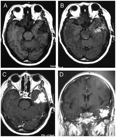 Large Capillary Hemangioma Of The Temporal Bone With A Dural Tail Sign