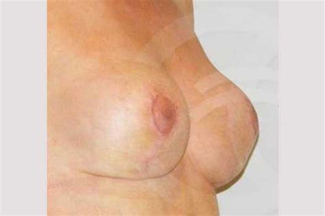 Breast Lift Before After Breast Uplift Oc Marbella Madrid Zurich
