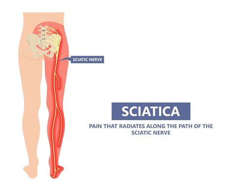 What Is Sciatica And How It Be Treated By A Physiotherapist