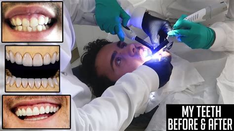 My Teeth Before And After Laser Gum Surgery And Veneers Youtube