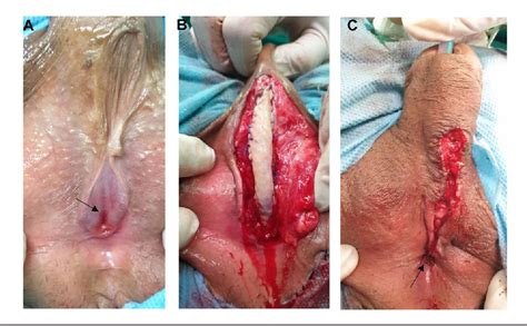 Figure From Ventral Onlay Buccal Mucosal Graft Urethroplasty Of A