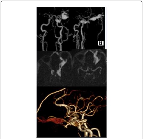Coronal Oblique And Axial Postcontrast MIP Images And SSD Image Show