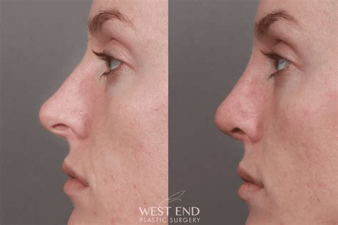 Rhinoplasty 2 Weeks Post Op Before And After Gallery Case 10109